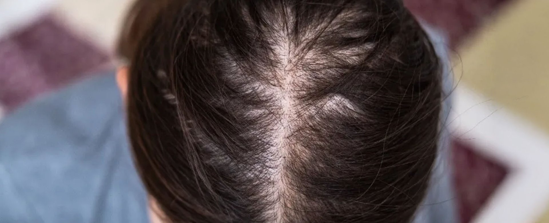 Kulit kepala menipis akibat rambut rontok, kondisi yang masih bisa tumbuh kembali dengan perawatan tepat