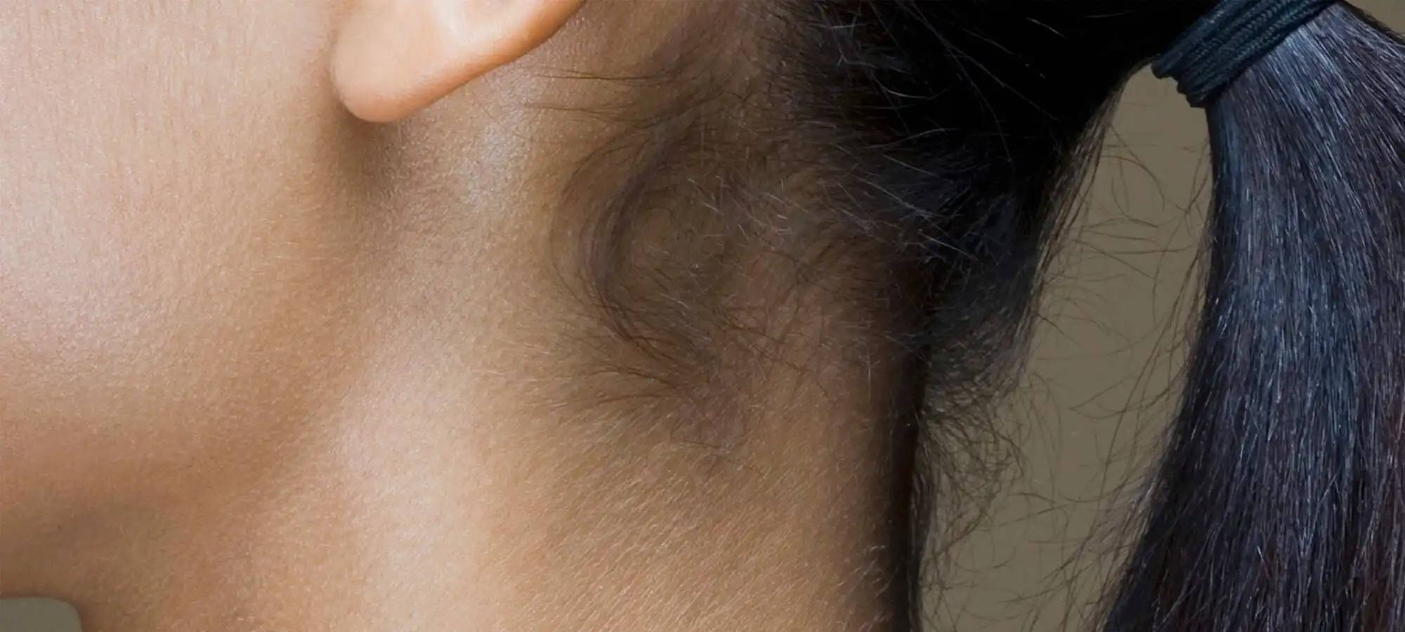 Cara Menghilangkan Ketombe Kering Dan Basah