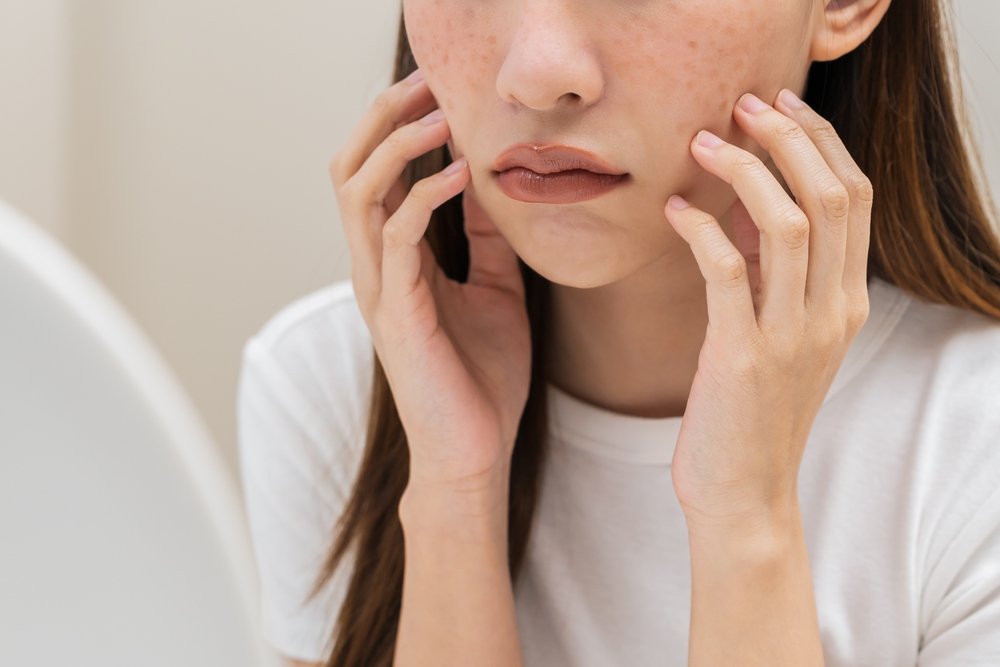 23 Cara Mengatasi Melasma Pada Wajah