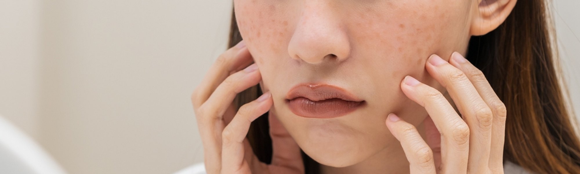 23 Cara Mengatasi Melasma Pada Wajah