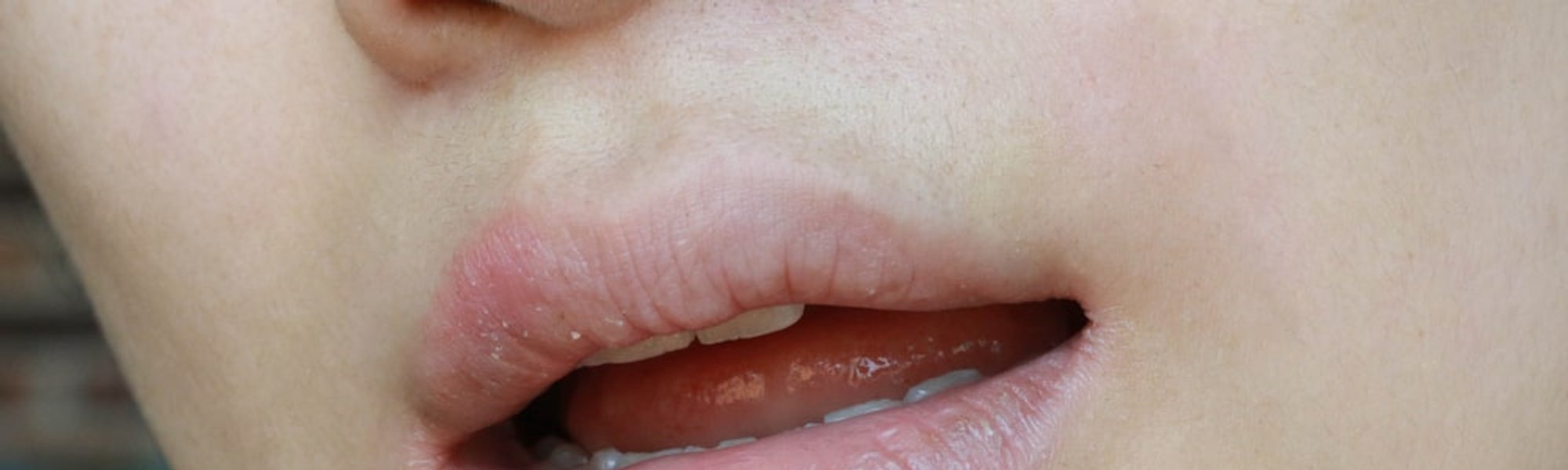 Cara Menghilangkan Bibir Hitam