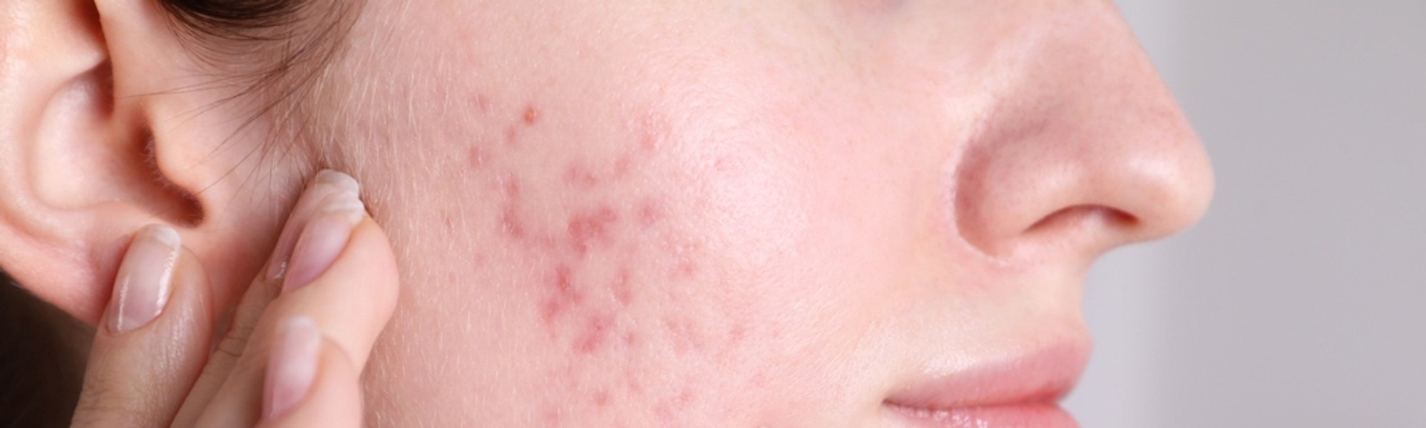 Kandungan Untuk Menghilangkan Bekas Jerawat