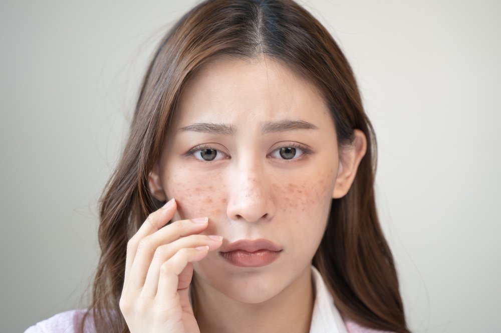 54 5 Penyebab Flek Hitam Di Hidung Dan Cara Menghilangkannya 1