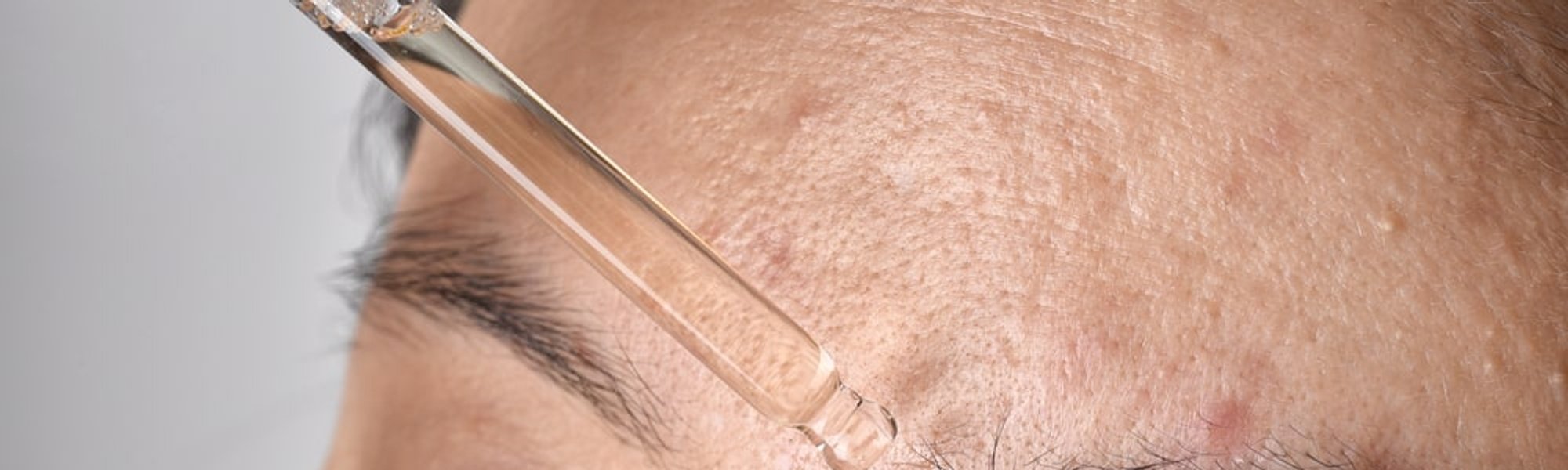 66 Bekas Jerawat Susah Hilang Cek Serum Penghilang Bekas Jerawat Dari LOreal Paris